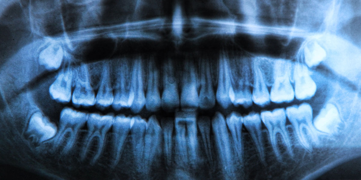 Cone Beam Scanner or Patient